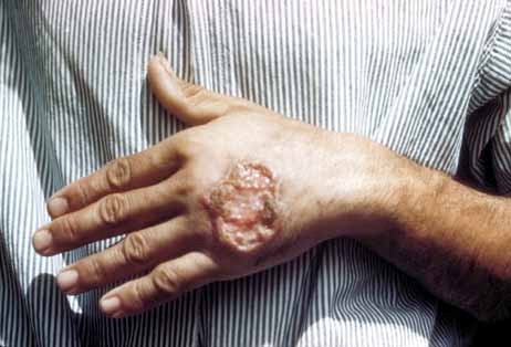 Cutaneous leishmaniasis or skin ulcer due to leishmaniasis on the hand of Central American adult. Source Centers for Disease Control and Prevention, credit Dr. D.S. Martin